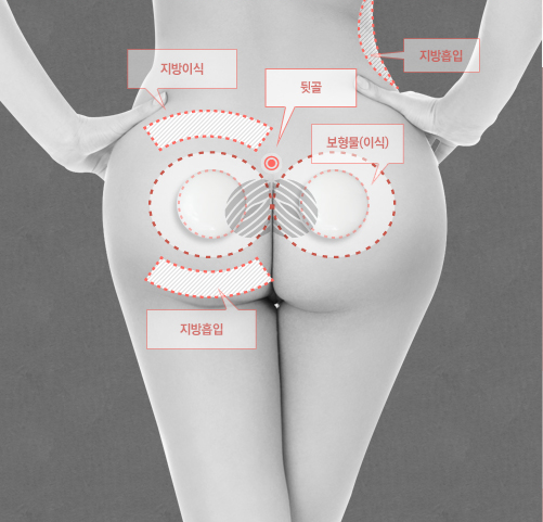 힙업수술후기 힙업수술비용 힙업수술가격 힙업수술사진 엉덩이힙업수술 ...