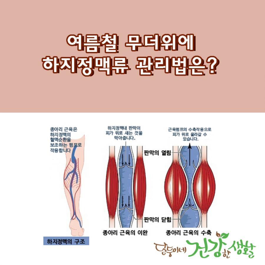 여름철 무더위에 하지정맥류 관리법은?