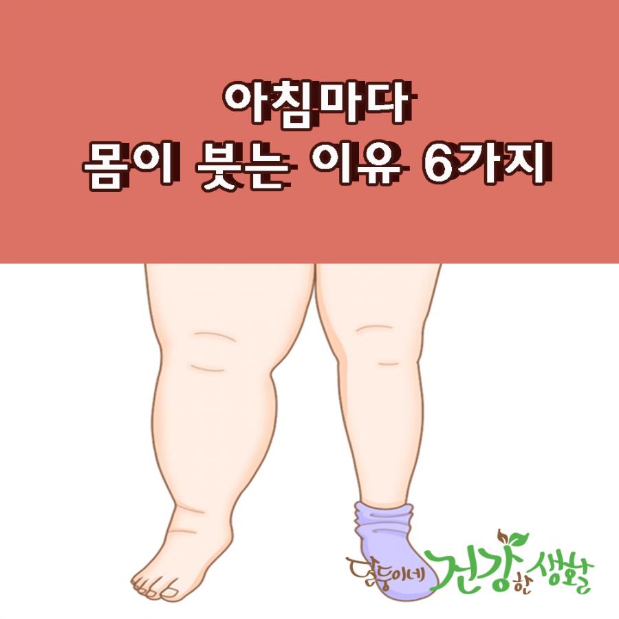 아침마다 몸이 붓는 이유 6가지 아침마다 몸이 붓는 이유 6가지